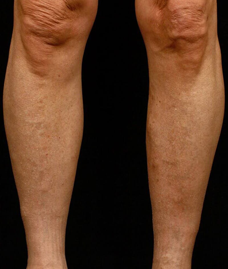 Endovenous Laser Therapy Before & After Gallery - Patient 37499466 - Image 2