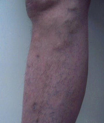 Endovenous Laser Therapy Before & After Gallery - Patient 37499473 - Image 2
