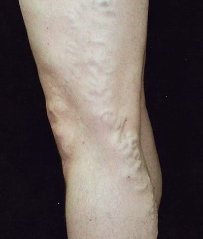 Endovenous Laser Therapy Before & After Gallery - Patient 37499478 - Image 1