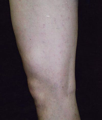 Endovenous Laser Therapy Before & After Gallery - Patient 37499478 - Image 2