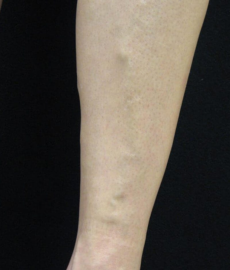 Endovenous Laser Therapy Before & After Gallery - Patient 37499484 - Image 1