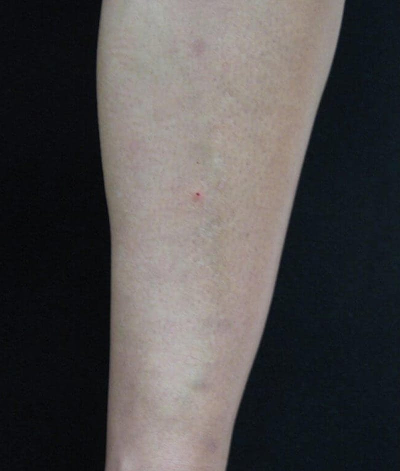Endovenous Laser Therapy Before & After Gallery - Patient 37499484 - Image 2