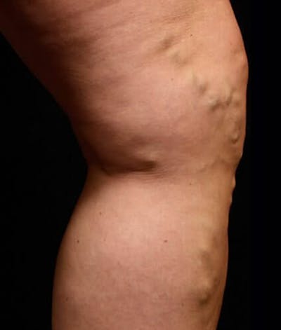 Endovenous Laser Therapy Before & After Gallery - Patient 37499495 - Image 1