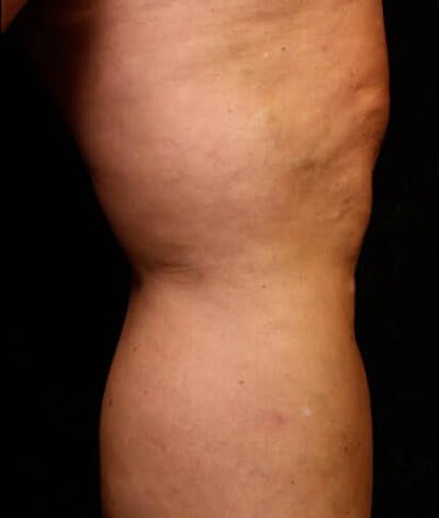 Endovenous Laser Therapy Before & After Gallery - Patient 37499495 - Image 2