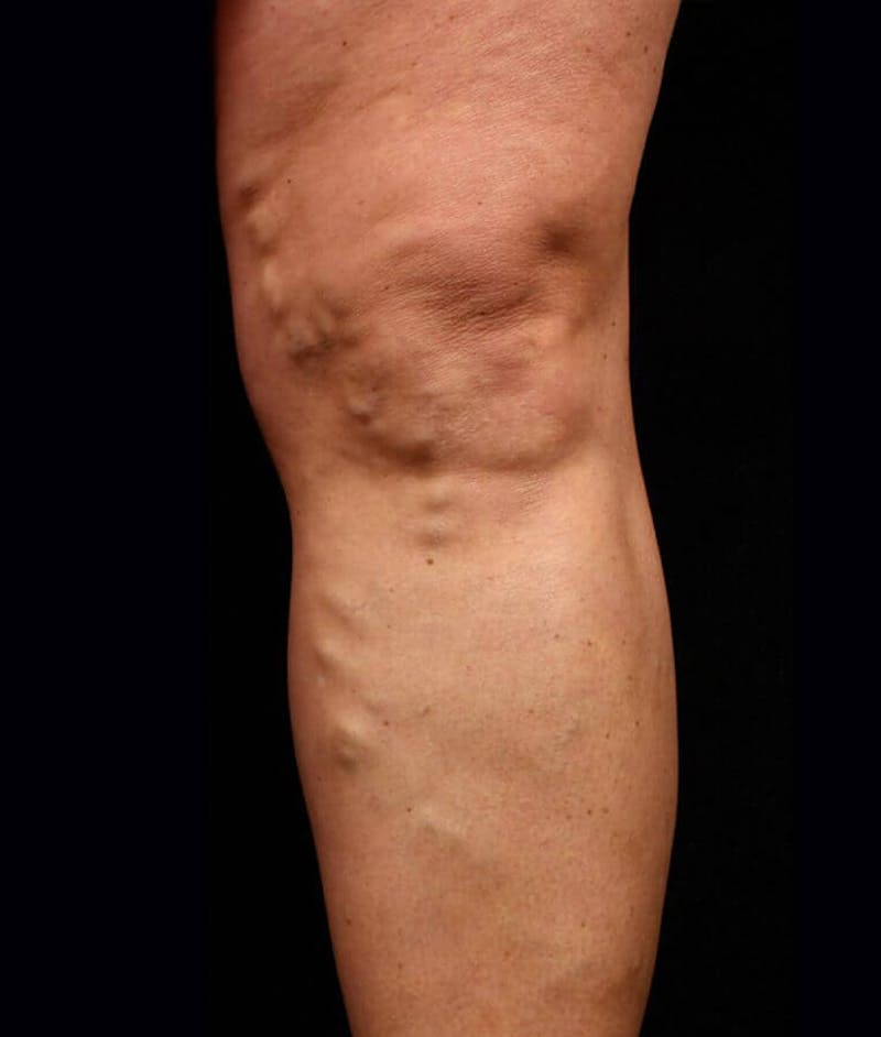 Endovenous Laser Therapy Before & After Gallery - Patient 37499506 - Image 1