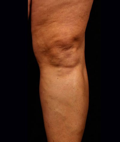 Endovenous Laser Therapy Before & After Gallery - Patient 37499506 - Image 2