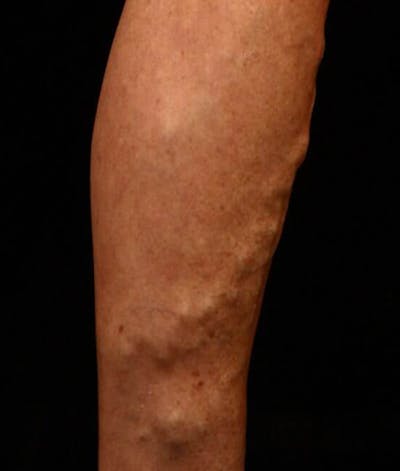 Endovenous Laser Therapy Before & After Gallery - Patient 37499516 - Image 1