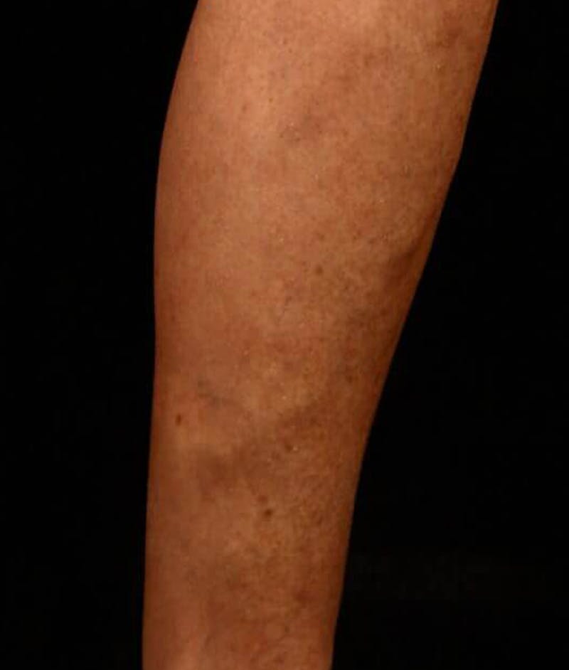 Endovenous Laser Therapy Before & After Gallery - Patient 37499516 - Image 2
