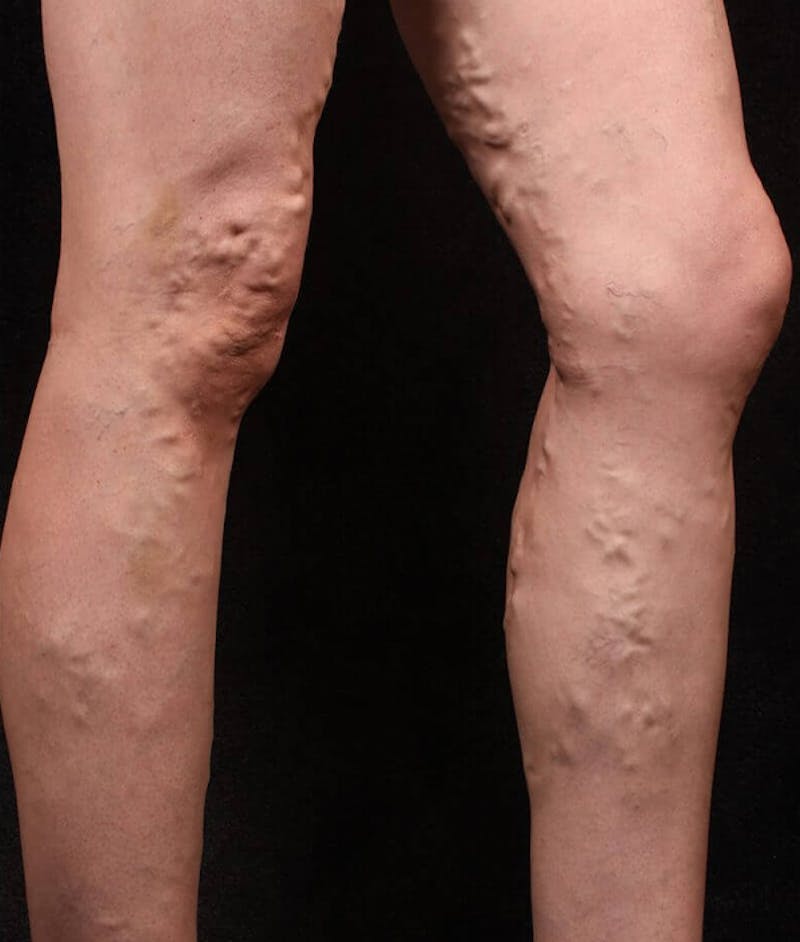 Endovenous Laser Therapy Before & After Gallery - Patient 37499526 - Image 1