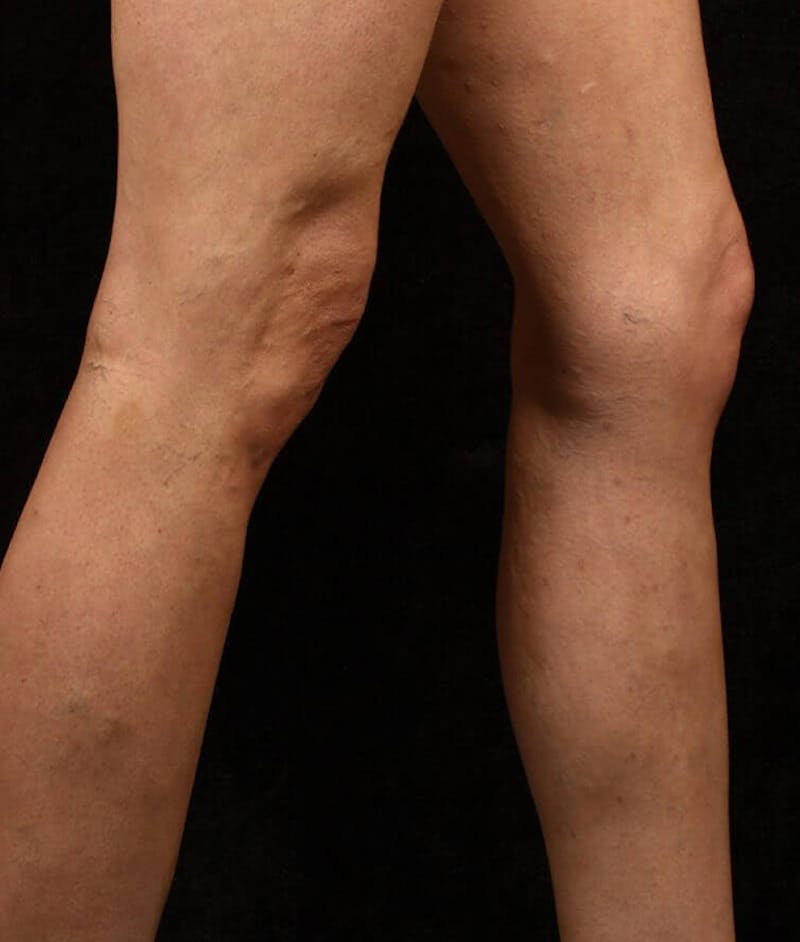 Endovenous Laser Therapy Before & After Gallery - Patient 37499526 - Image 2