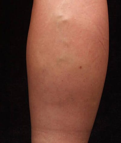 Endovenous Laser Therapy Before & After Gallery - Patient 37499537 - Image 1