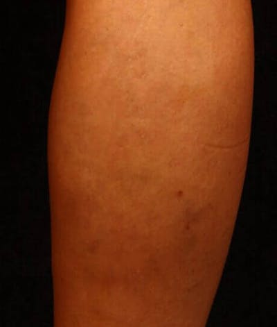 Endovenous Laser Therapy Before & After Gallery - Patient 37499537 - Image 2