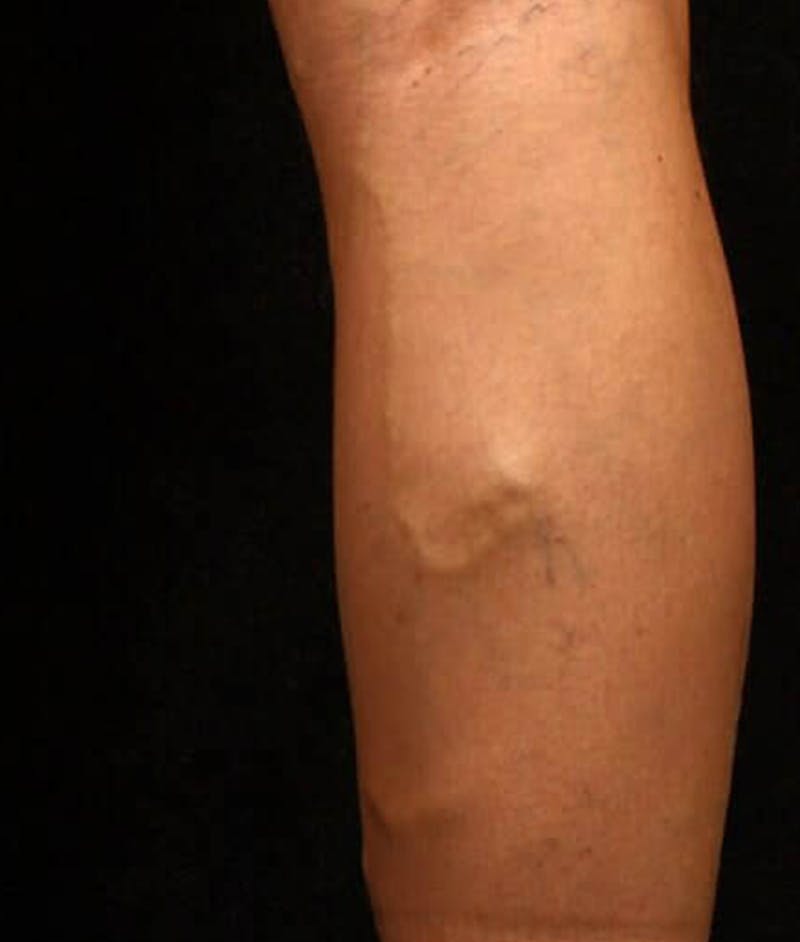 Endovenous Laser Therapy Before & After Gallery - Patient 37499548 - Image 1