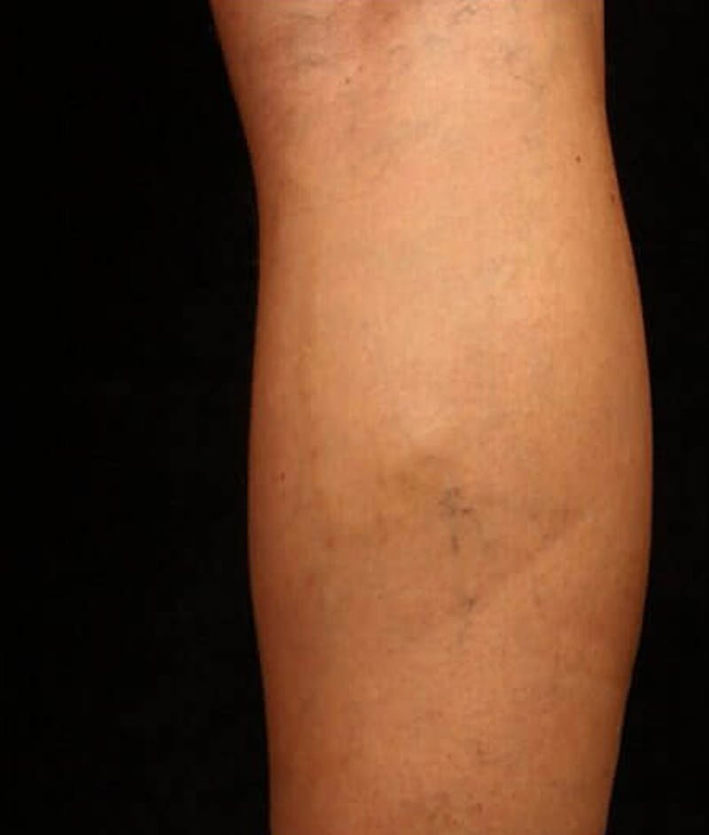 Endovenous Laser Therapy Before & After Gallery - Patient 37499548 - Image 2