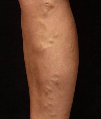 Endovenous Laser Therapy Before & After Gallery - Patient 37499558 - Image 1