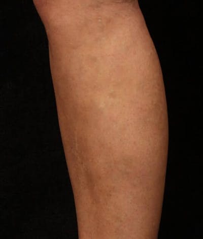 Endovenous Laser Therapy Before & After Gallery - Patient 37499558 - Image 2