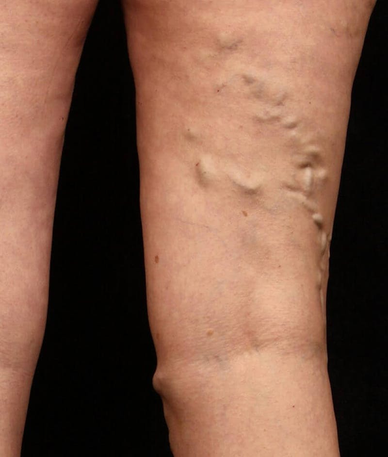 Endovenous Laser Therapy Before & After Gallery - Patient 37499567 - Image 1