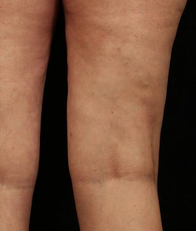 Endovenous Laser Therapy Before & After Gallery - Patient 37499567 - Image 2