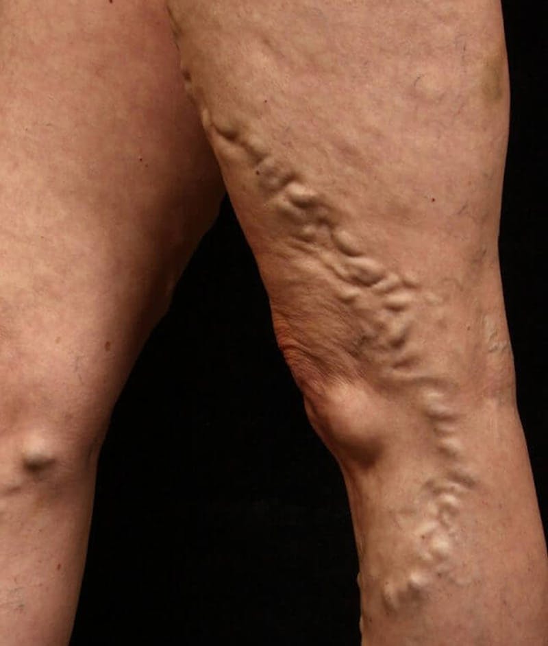Endovenous Laser Therapy Before & After Gallery - Patient 37499577 - Image 1