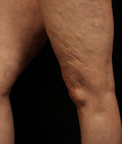 Endovenous Laser Therapy Before & After Gallery - Patient 37499577 - Image 2