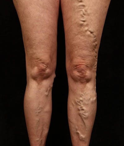 Endovenous Laser Therapy Before & After Gallery - Patient 37499582 - Image 1