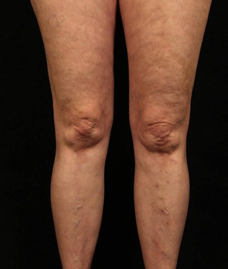 Endovenous Laser Therapy Before & After Gallery - Patient 37499582 - Image 2