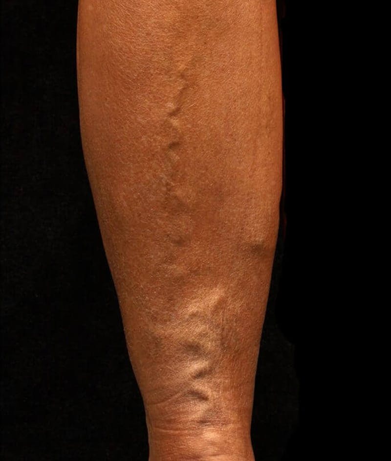 Endovenous Laser Therapy Before & After Gallery - Patient 37499588 - Image 1