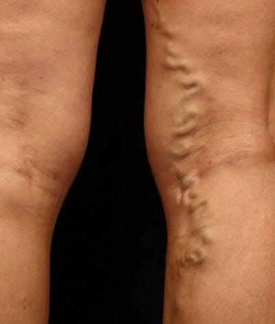 Endovenous Laser Therapy Before & After Gallery - Patient 37499596 - Image 1