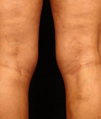 Endovenous Laser Therapy Before & After Gallery - Patient 37499596 - Image 2