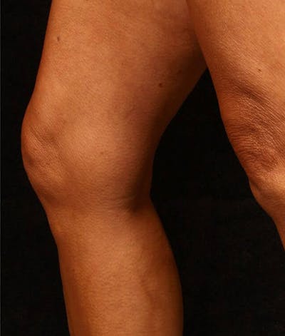 Endovenous Laser Therapy Before & After Gallery - Patient 37499607 - Image 2
