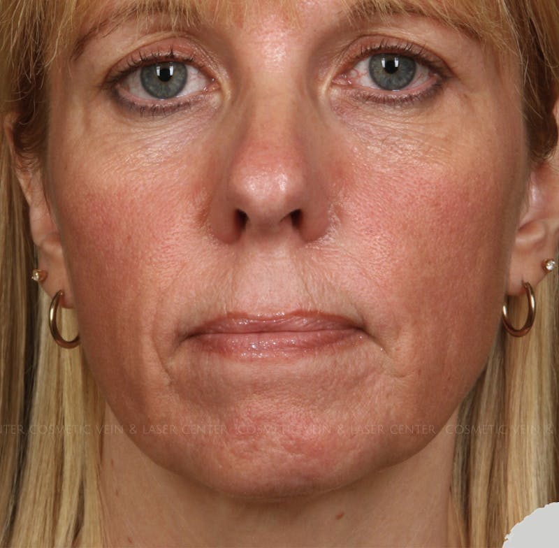 Cosmetic Filler Augmentation Before & After Gallery - Patient 320406 - Image 1