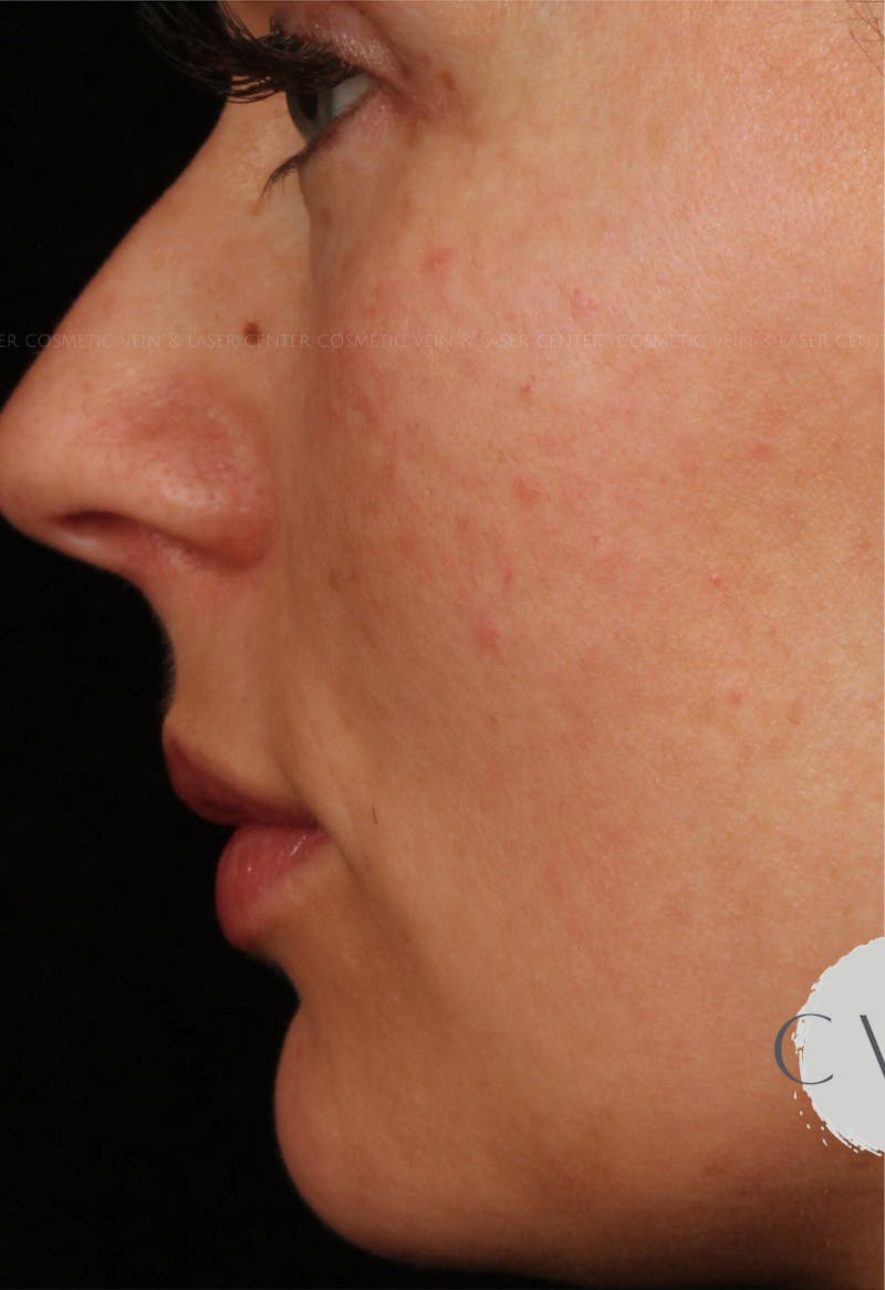 Cosmetic Filler Augmentation Before & After Gallery - Patient 381068 - Image 1