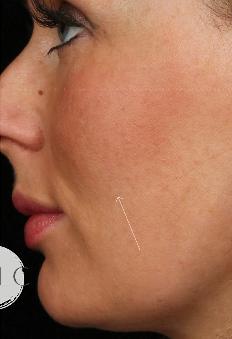 Cosmetic Filler Augmentation Before & After Gallery - Patient 381068 - Image 2