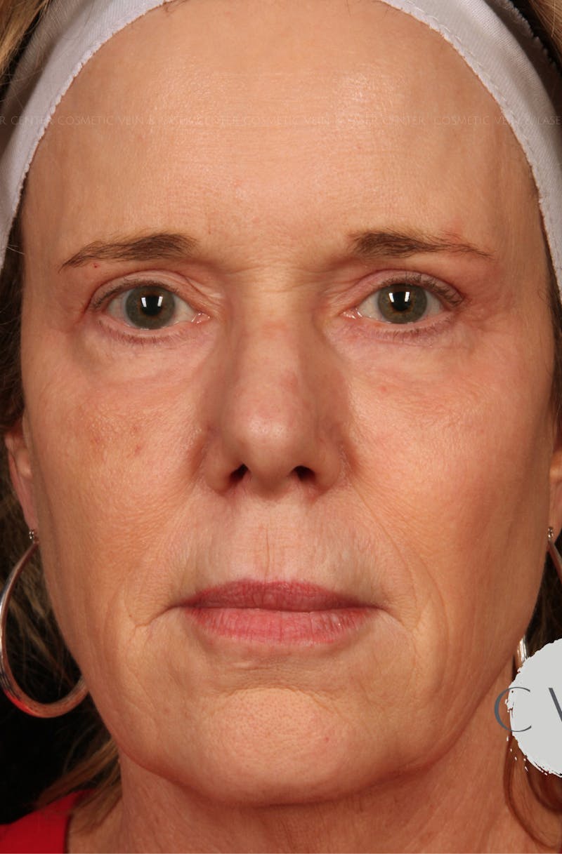 Cosmetic Filler Augmentation Before & After Gallery - Patient 687908 - Image 1