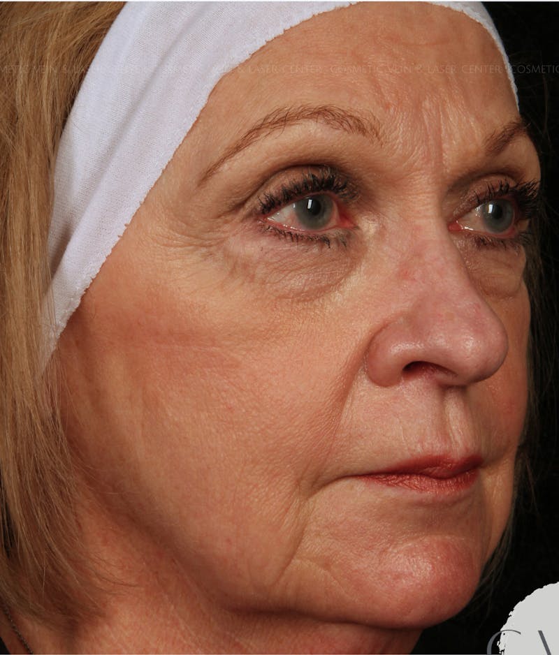 Cosmetic Filler Augmentation Before & After Gallery - Patient 304136 - Image 1