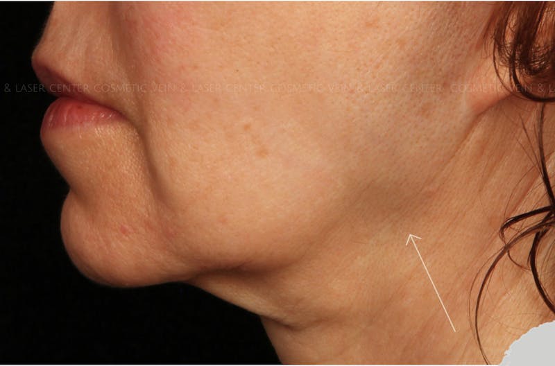 Cosmetic Filler Augmentation Before & After Gallery - Patient 398621 - Image 1