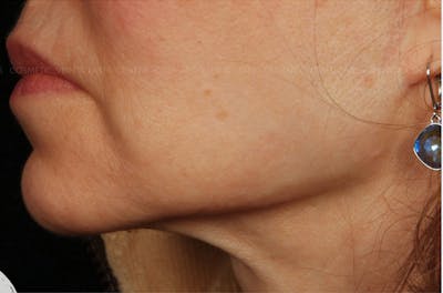 Cosmetic Filler Augmentation Before & After Gallery - Patient 398621 - Image 2