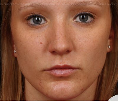 Cosmetic Filler Augmentation Before & After Gallery - Patient 381318 - Image 1
