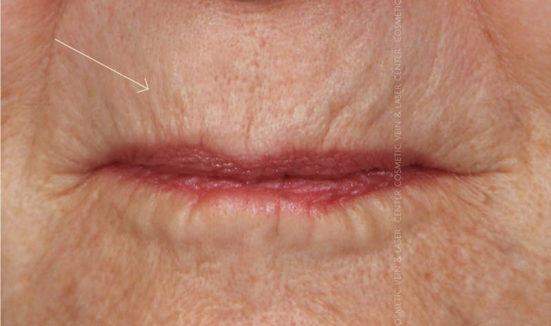 Cosmetic Filler Augmentation Before & After Gallery - Patient 487874 - Image 1