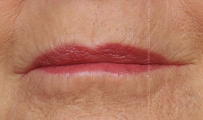 Cosmetic Filler Augmentation Before & After Gallery - Patient 487874 - Image 2