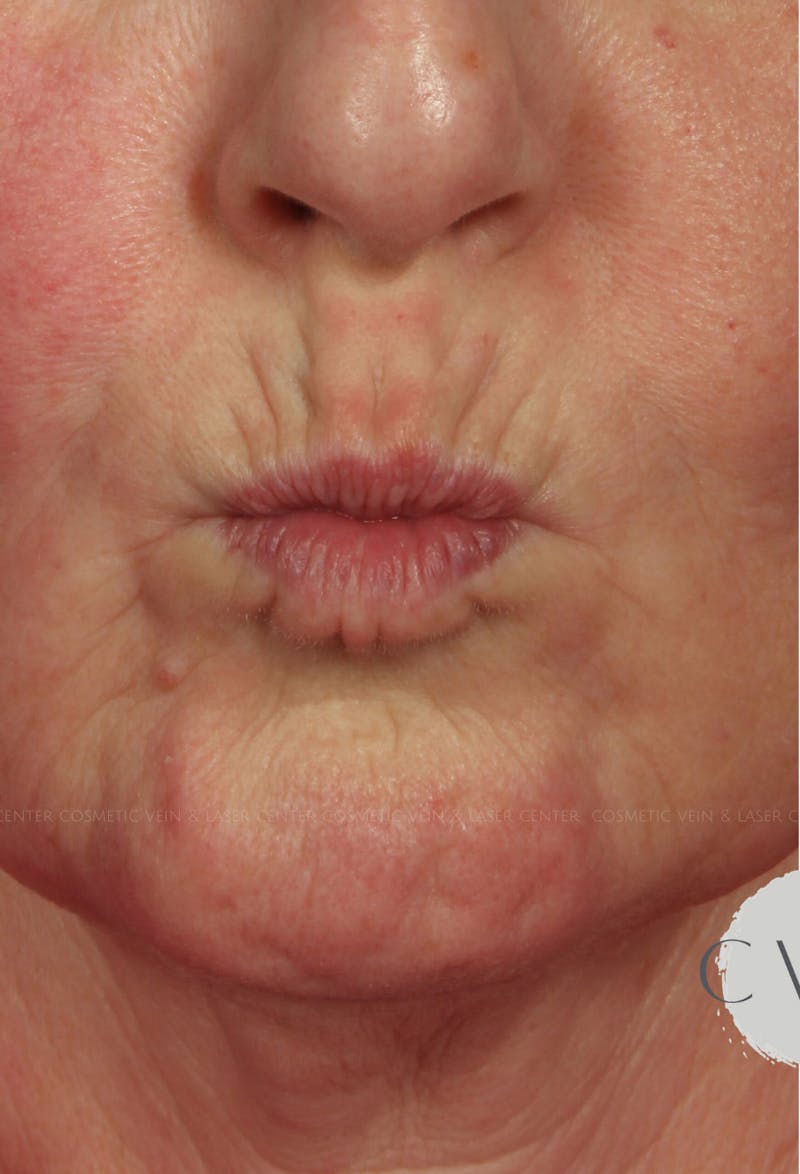 Cosmetic Filler Augmentation Before & After Gallery - Patient 303178 - Image 1