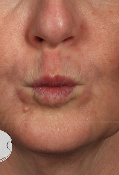 Cosmetic Filler Augmentation Before & After Gallery - Patient 303178 - Image 2