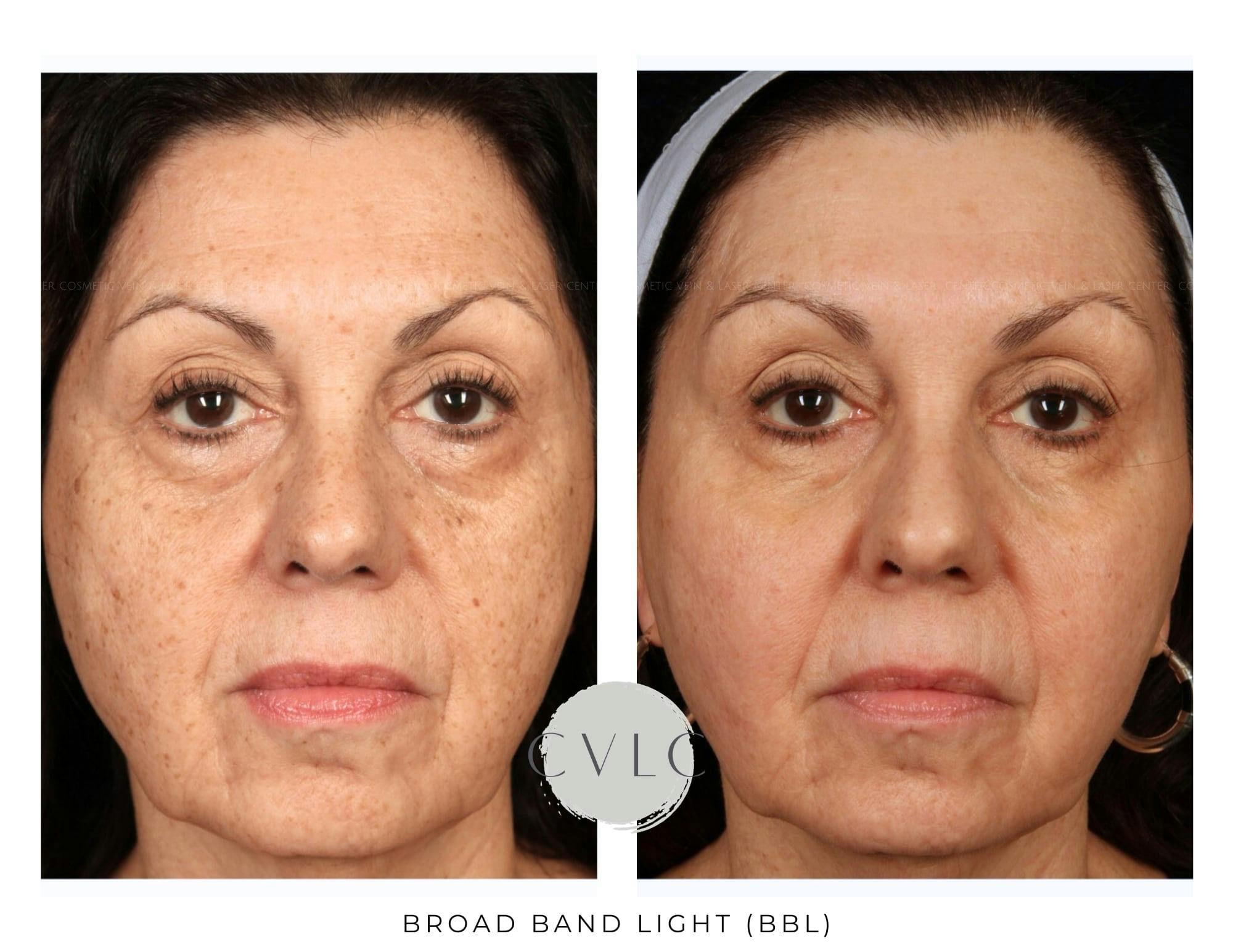 BBL: Forever Young (Broad Band Light) Before & After Gallery - Patient 235538 - Image 1