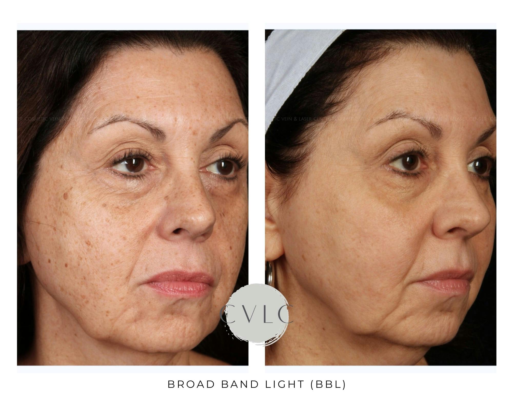 BBL: Forever Young (Broad Band Light) Before & After Gallery - Patient 235538 - Image 2