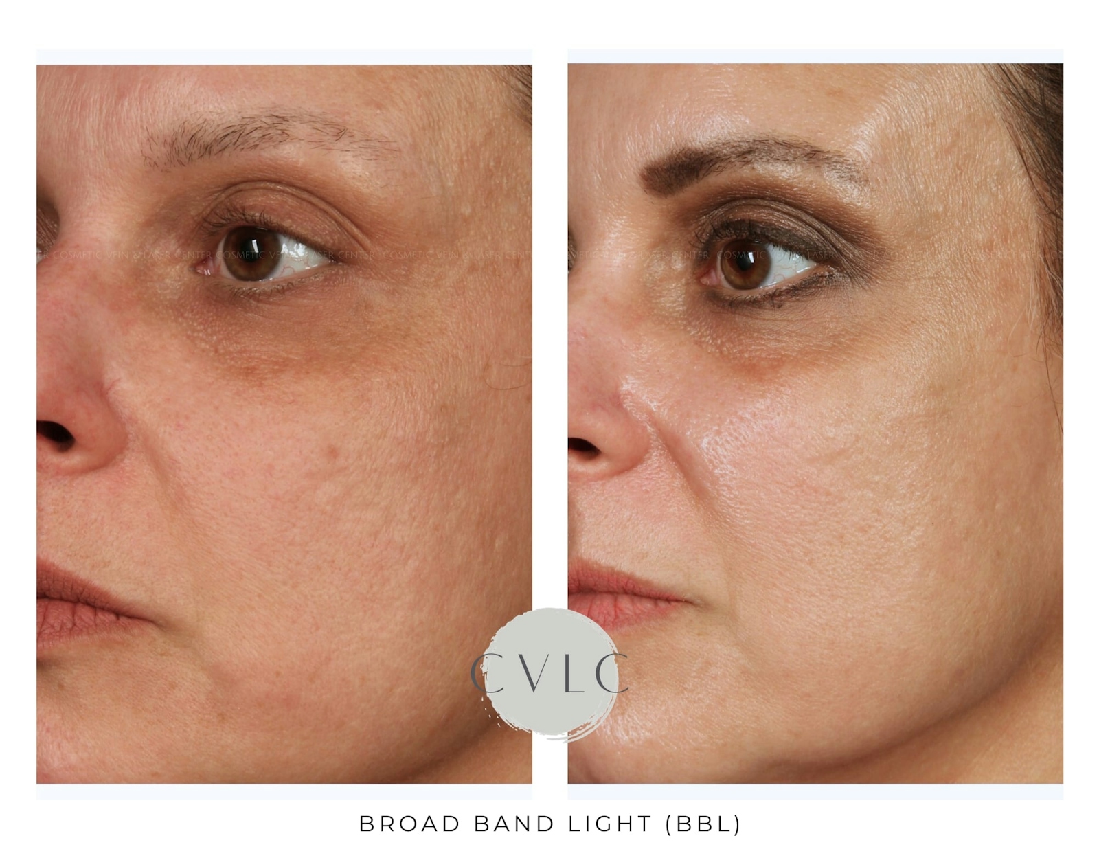 BBL: Forever Young (Broad Band Light) Before & After Gallery - Patient 100232 - Image 1