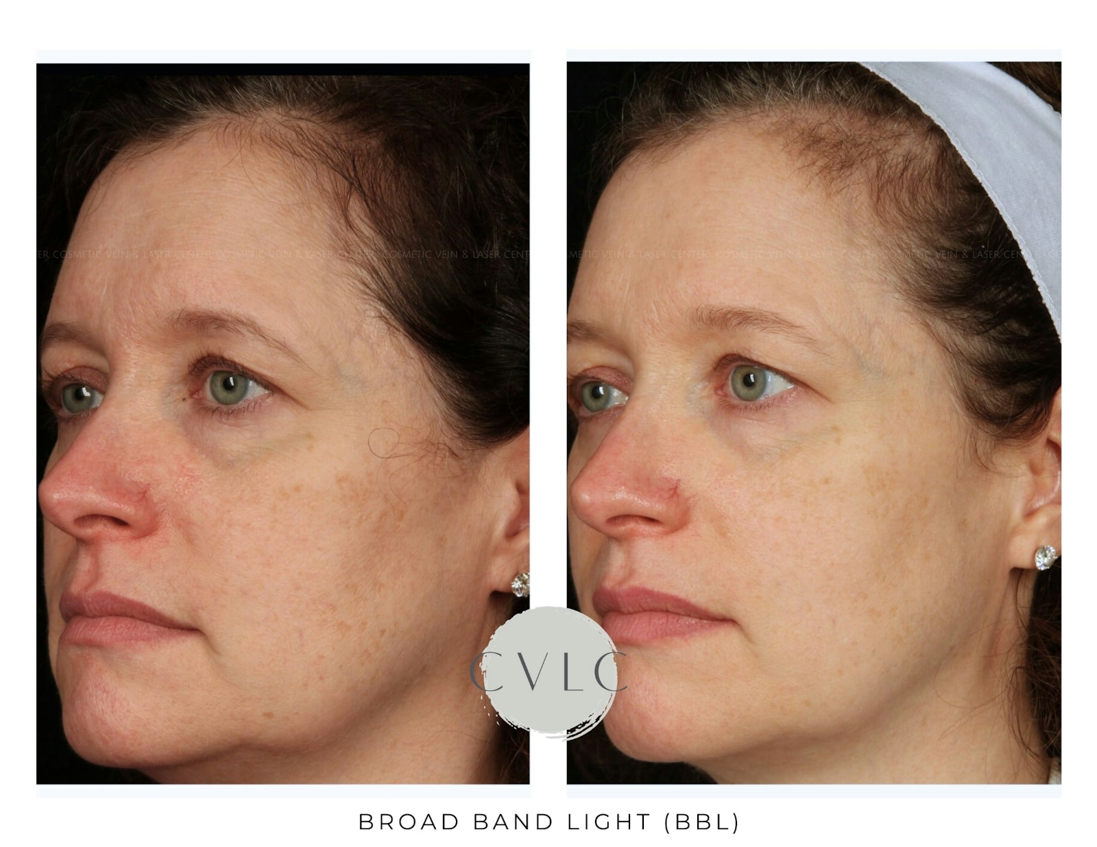 BBL: Forever Young (Broad Band Light) Before & After Gallery - Patient 407580 - Image 1