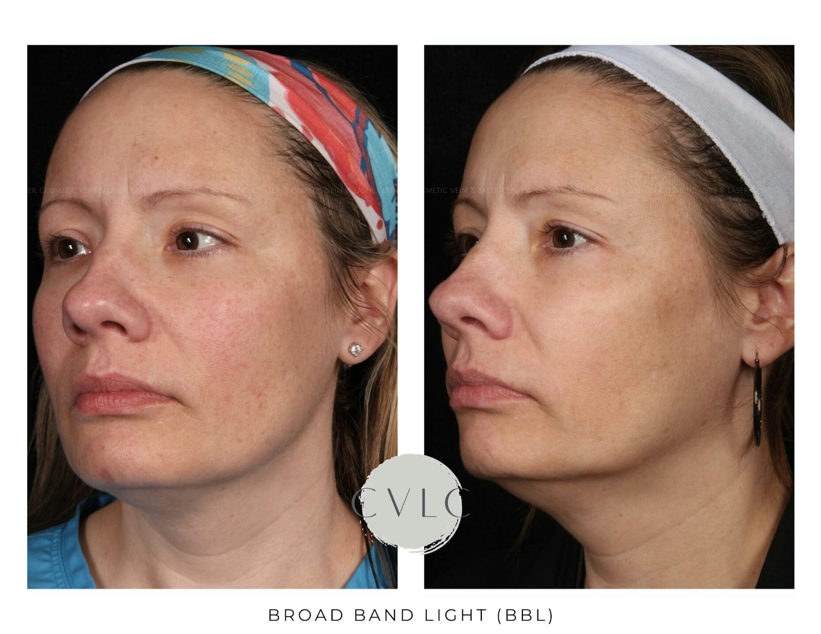 BBL: Forever Young (Broad Band Light) Before & After Gallery - Patient 120083 - Image 1