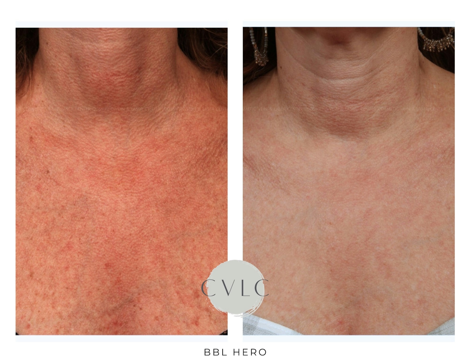 BBL: Forever Young (Broad Band Light) Before & After Gallery - Patient 473196 - Image 1