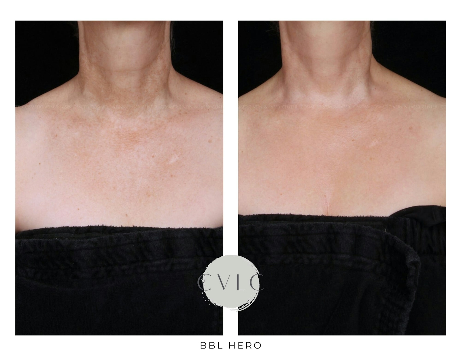 BBL: Forever Young (Broad Band Light) Before & After Gallery - Patient 647028 - Image 1