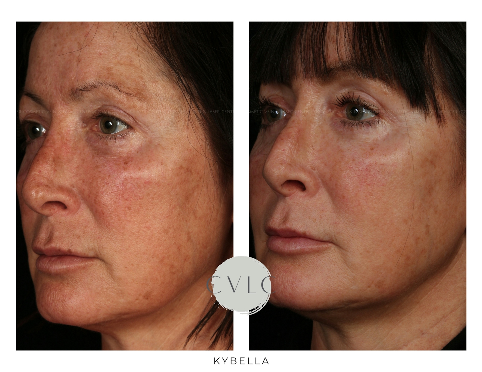 Kybella Before & After Gallery - Patient 383448 - Image 1